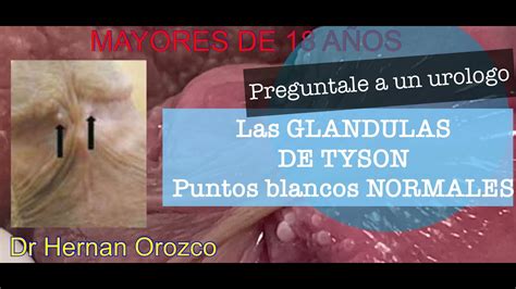 que son las glandulas tyson|Glándulas de Tyson o pápulas perladas